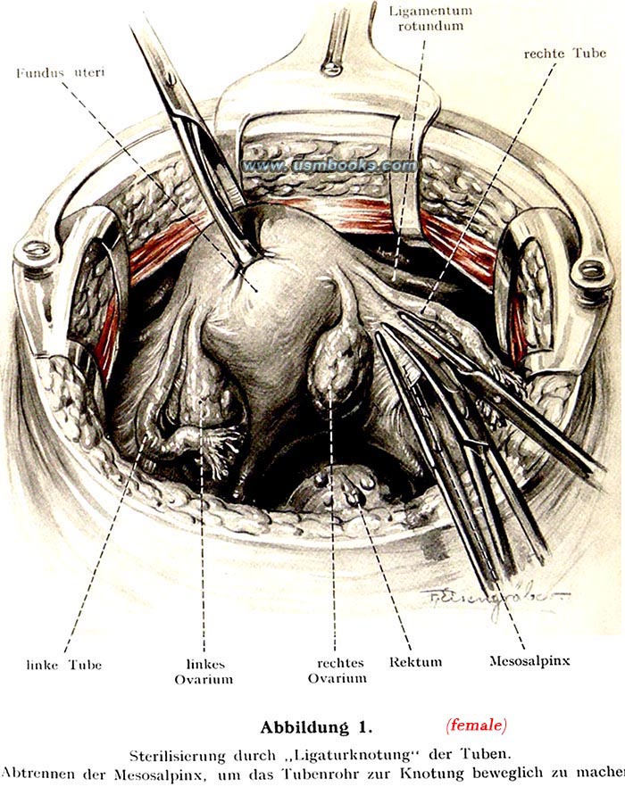 Nazi female sterilization illustration